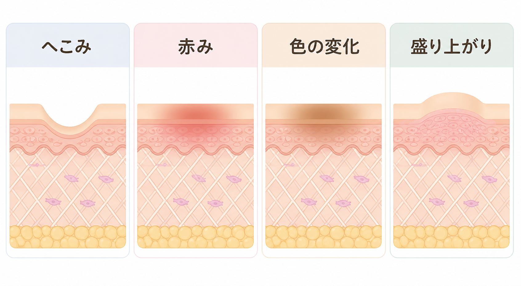 へこみ、赤み、色の変化、盛り上がりというニキビ跡の見え方を並べて示す図